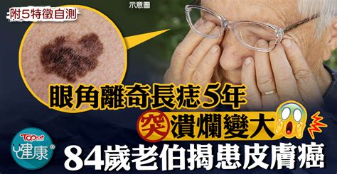 蛋蛋長痣|陰囊長痣：就診科室與皮膚問題辨識